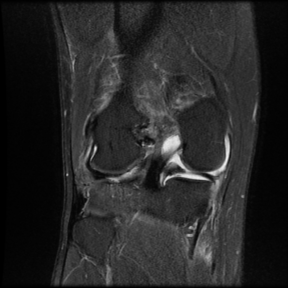 File:Anterior cruciate ligament graft tear and bucket-handle tear of medial meniscus (Radiopaedia 75867-87255 Coronal PD fat sat 18).jpg