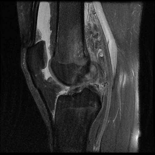 File:Anterior cruciate ligament tear (Radiopaedia 61500-69462 Sagittal PD fat sat 11).jpg