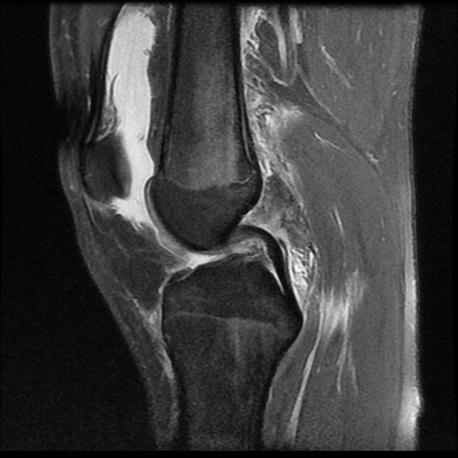 File:Anterior cruciate ligament tear (Radiopaedia 61500-69462 Sagittal PD fat sat 9).jpg
