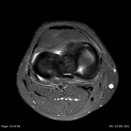 File:Anterior cruciate ligament tear (Radiopaedia 70783-80964 Axial PD fat sat 13).jpg