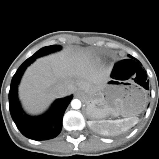 Anterior mediastinal lymphoma (Radiopaedia 29556-30061 C 48).jpg