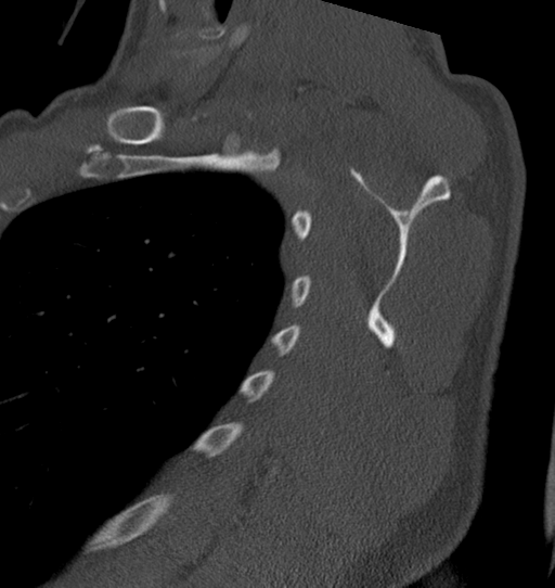 Anterior shoulder dislocation with Hill-Sachs and bony Bankart lesions (Radiopaedia 40424-42974 Sagittal bone window 40).png