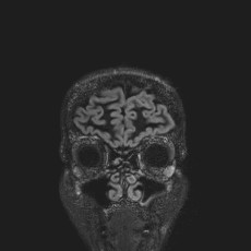 Anterior temporal encephalocele (Radiopaedia 82624-96808 Coronal FLAIR 5).jpg
