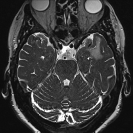 File:Anterior temporal pole cysts (Radiopaedia 46629-51102 Axial 33).png