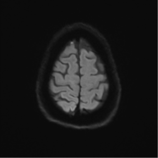 File:Anterior temporal pole cysts (Radiopaedia 46629-51102 Axial DWI 51).png