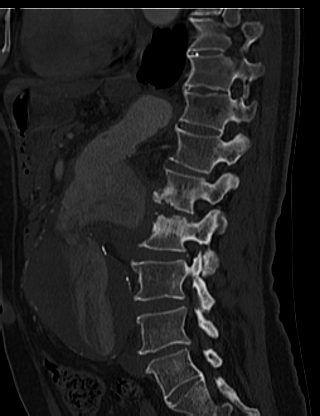 File:Anterior vertebral scalloping (abdominal aortic aneurysm) (Radiopaedia 66744-76067 Sagittal bone window 51).jpg