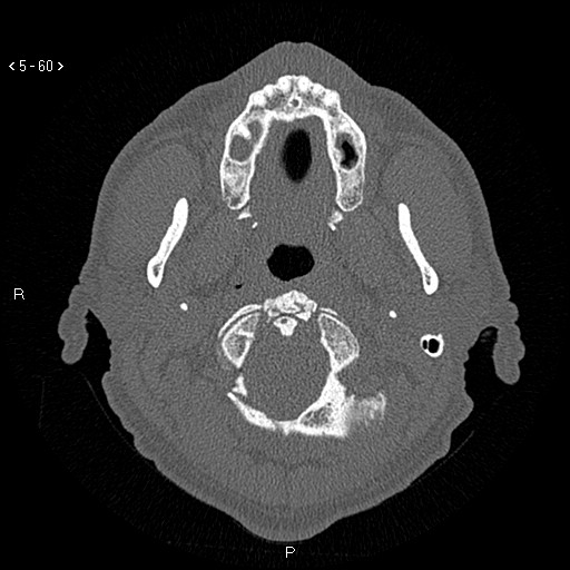 Antrochoanal Polyp (Radiopaedia 70510-80631 Axial bone window 8).jpg