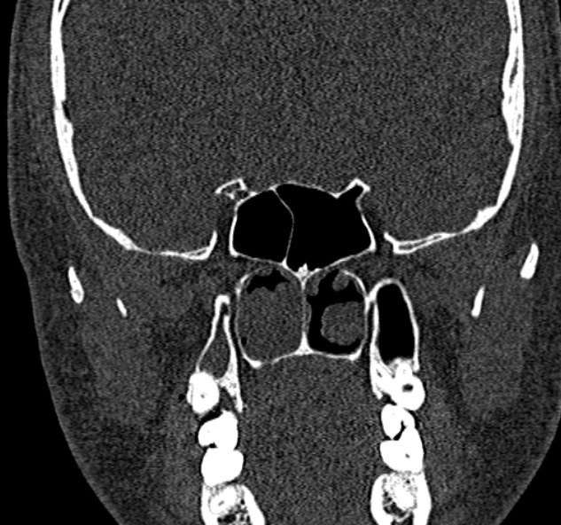 Antrochoanal polyp (Radiopaedia 30002-30554 Coronal bone window 55).jpg