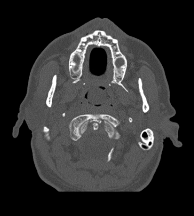 Antrochoanal polyp (Radiopaedia 79011-92169 Axial bone window 5).jpg