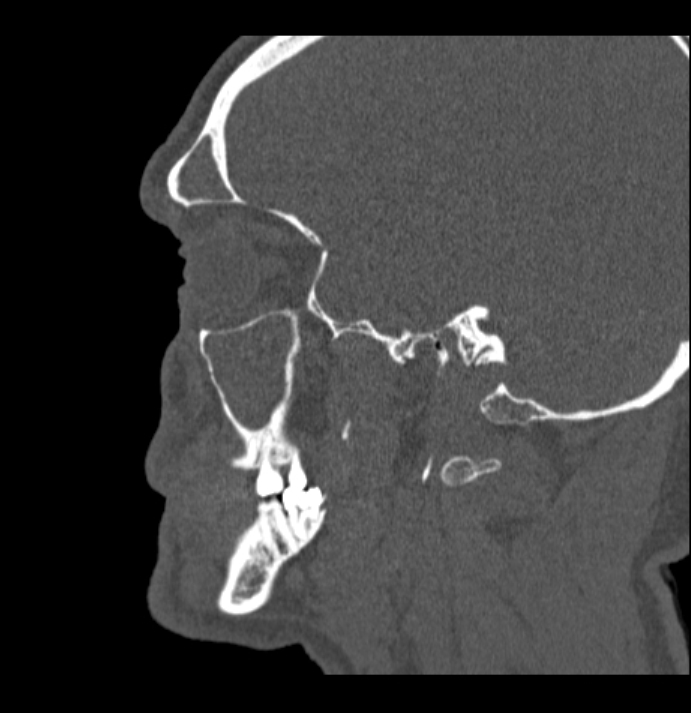 Antrochoanal polyp (Radiopaedia 79011-92169 Sagittal bone window 61).jpg