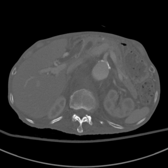 Aortic aneurysm with spinal destruction (Radiopaedia 42301-45410 Axial bone window 27).jpg