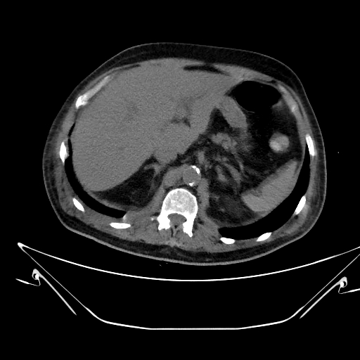 Aortic arch aneurysm (Radiopaedia 84109-99365 Axial non-contrast 277).jpg