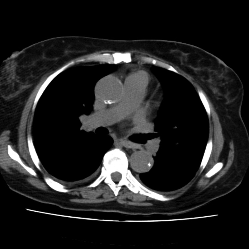 Aortic arch pseudoaneurysm (Radiopaedia 8534-9368 Axial non-contrast 36).jpg