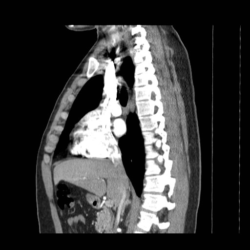 File:Aortic arch stent (Radiopaedia 30030-30595 E 2).jpg
