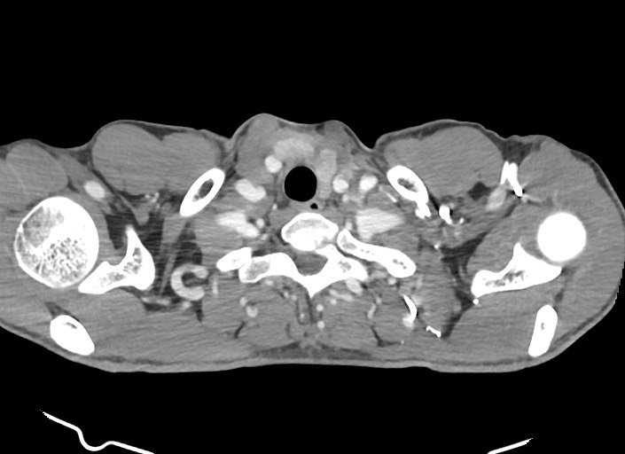 File:Aortic coarctation with aneurysm (Radiopaedia 74818-85828 A 182).jpg