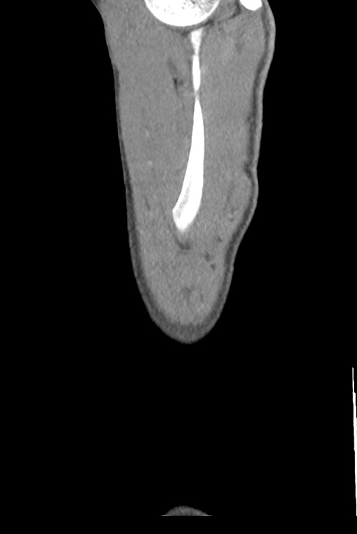 Aortic coarctation with aneurysm (Radiopaedia 74818-85828 B 158).jpg