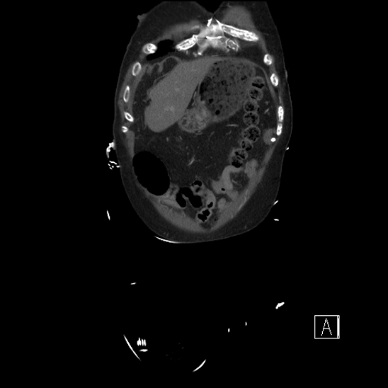 Aortic dissection (CTPA) (Radiopaedia 75506-86750 F 5).jpg