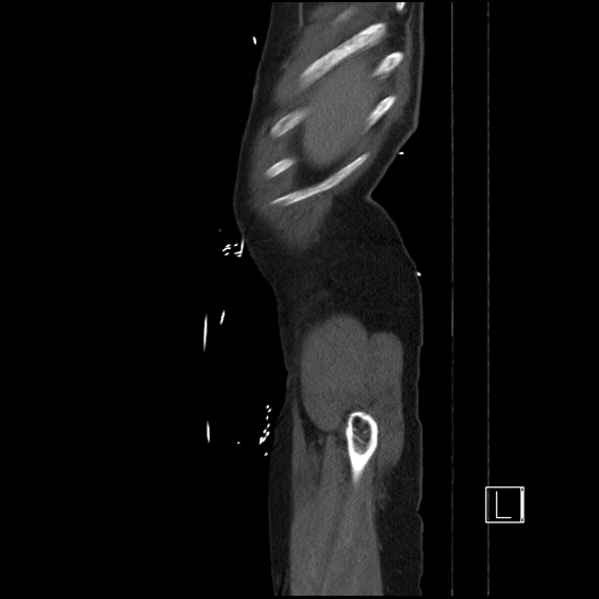 Aortic dissection (CTPA) (Radiopaedia 75506-86750 G 4).jpg