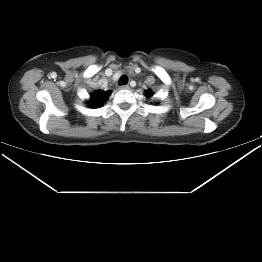 File:Aortic dissection (Radiopaedia 25350-25604 C 2).jpg