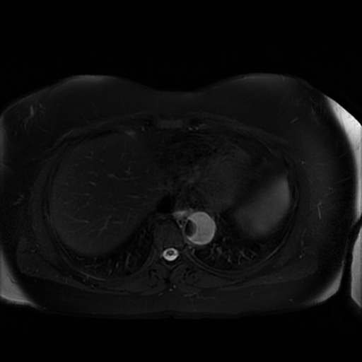 File:Aortic dissection (Radiopaedia 57969-64956 Axial T2 fat sat 10).jpg