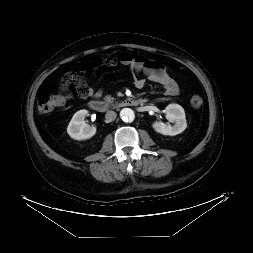 Aortic dissection (Radiopaedia 62562-71000 A 66).jpg
