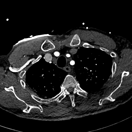 File:Aortic dissection - DeBakey type II (Radiopaedia 64302-73082 A 18).png