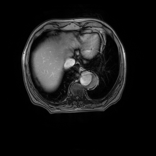 File:Aortic dissection - Stanford A - DeBakey I (Radiopaedia 23469-23551 Axial MRA 29).jpg