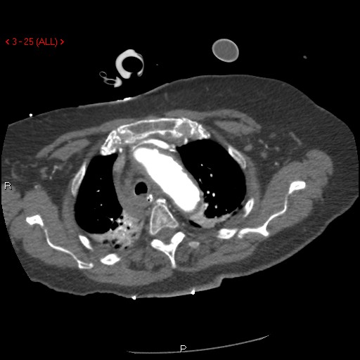 Aortic intramural hematoma (Radiopaedia 27746-28001 A 25).jpg