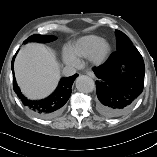 Aortic intramural hematoma (Radiopaedia 34260-35540 Axial non-contrast 49).png