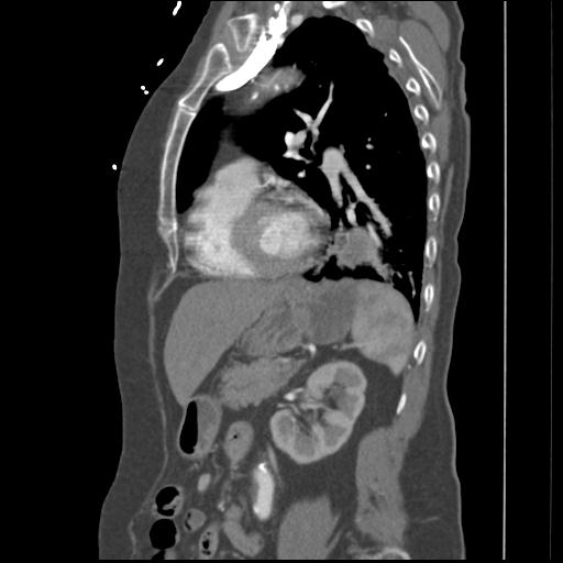 File:Aortic intramural hematoma from penetrating atherosclerotic ulcer (Radiopaedia 31137-31836 B 8).jpg