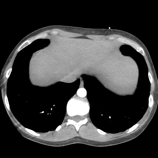 File:Aortic valve non-coronary cusp thrombus (Radiopaedia 55661-62189 B 42).png