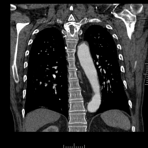 File:Aorto-coronary bypass graft aneurysms (Radiopaedia 40562-43157 B 33).png