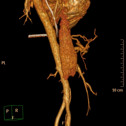 File:Aorto-left renal vein fistula (Radiopaedia 45534-49628 D 23).jpg