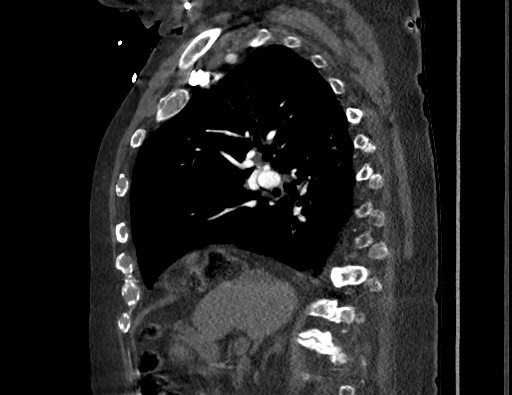 File:Aortoesophageal fistula with endovascular repair (Radiopaedia 73781-84592 Sagittal C+ CTPA 73).jpg