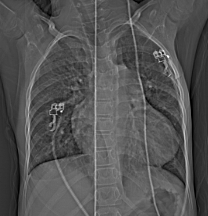 File:Aortopulmonary window, interrupted aortic arch and large PDA giving the descending aorta (Radiopaedia 35573-37074 Scout 1).jpg