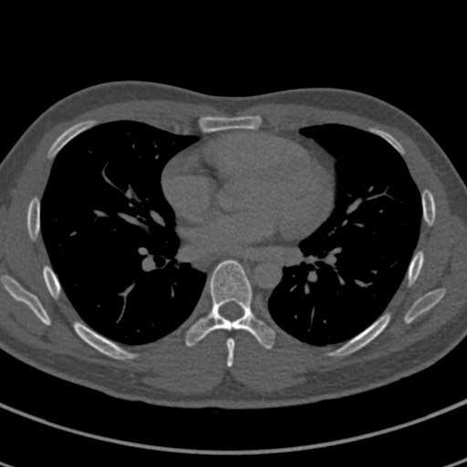 Apical lung mass mimic - neurogenic tumor (Radiopaedia 59918-67521 Axial bone window 46).jpg