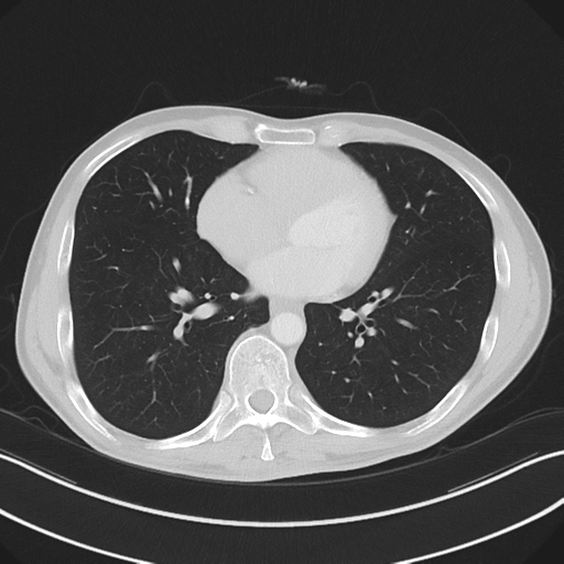 Apical pleural calcification (Radiopaedia 46141-50499 Axial lung window 44).png