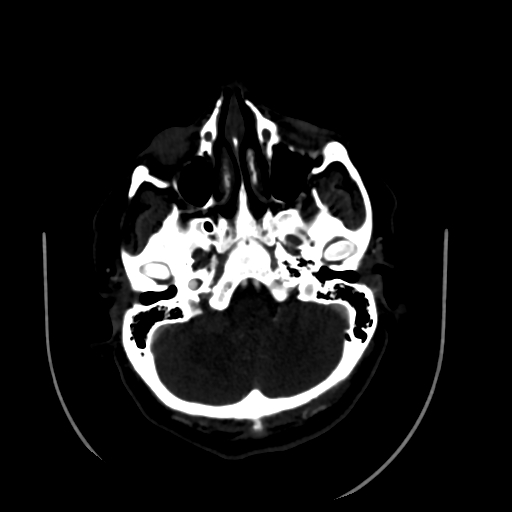 File:Aplasia of the internal carotid artery (Radiopaedia 61082-68960 A 15).jpg