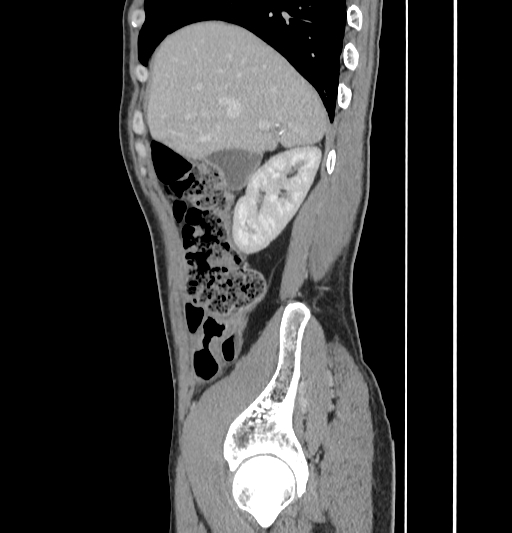 Appendiceal mucinous adenocarcinoma (Radiopaedia 66605-75922 C 15).jpg
