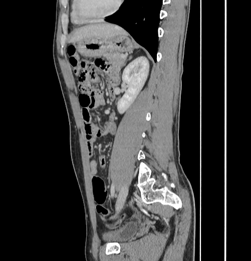 Appendiceal mucinous adenocarcinoma (Radiopaedia 66605-75922 C 44).jpg