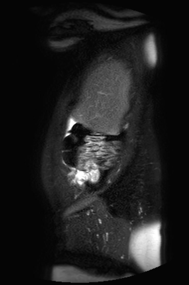 Appendicitis in gravida (MRI) (Radiopaedia 89433-106395 Sagittal T2 SPAIR 56).jpg