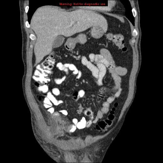 File:Appendicitis mass in inguinal hernia (Radiopaedia 26858-27029 B 18).jpg