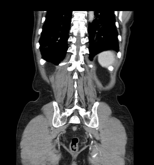 File:Appendicitis with localized perforation and abscess formation (Radiopaedia 49035-54130 B 41).jpg