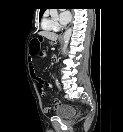 File:Appendicitis with localized perforation and abscess formation (Radiopaedia 49035-54130 C 36).jpg