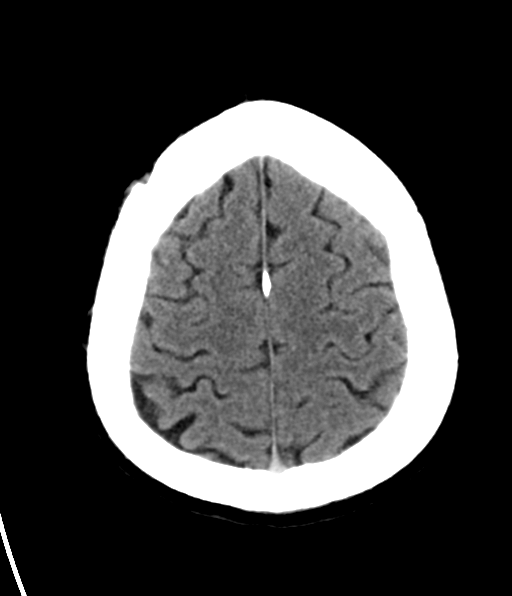 File:Aqueduct stenosis with corpus callosum hypoattenuation post shunting (Radiopaedia 37212-38973 Axial non-contrast 27).png