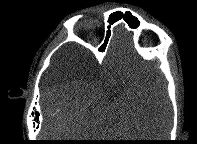 Arachnoid cyst- extremely large (Radiopaedia 68741-78450 Axial bone window 35).jpg