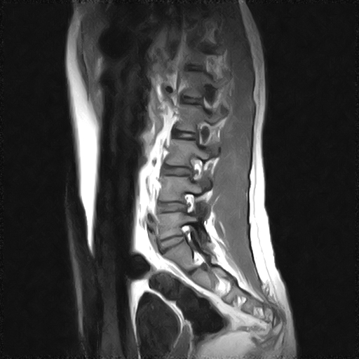 File:Arachnoid cyst - spinal (Radiopaedia 66835-76157 Sagittal T1 9).jpg