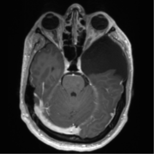Arachnoid cyst with subdural hematoma (Radiopaedia 85892-101743 Axial T1 C+ 31).png