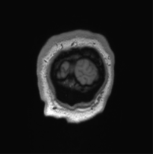 File:Arachnoid cyst with subdural hematoma (Radiopaedia 85892-101743 Coronal T1 1).png