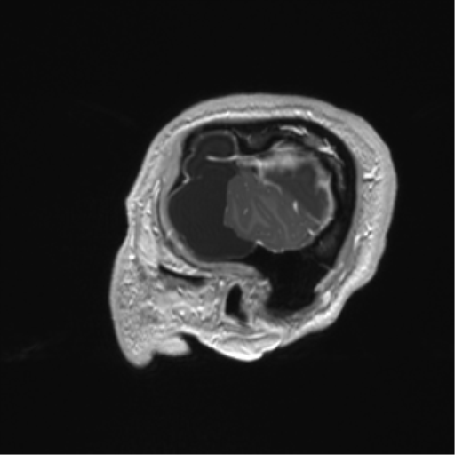 Arachnoid cyst with subdural hematoma (Radiopaedia 85892-101743 Sagittal T1 C+ 12).png